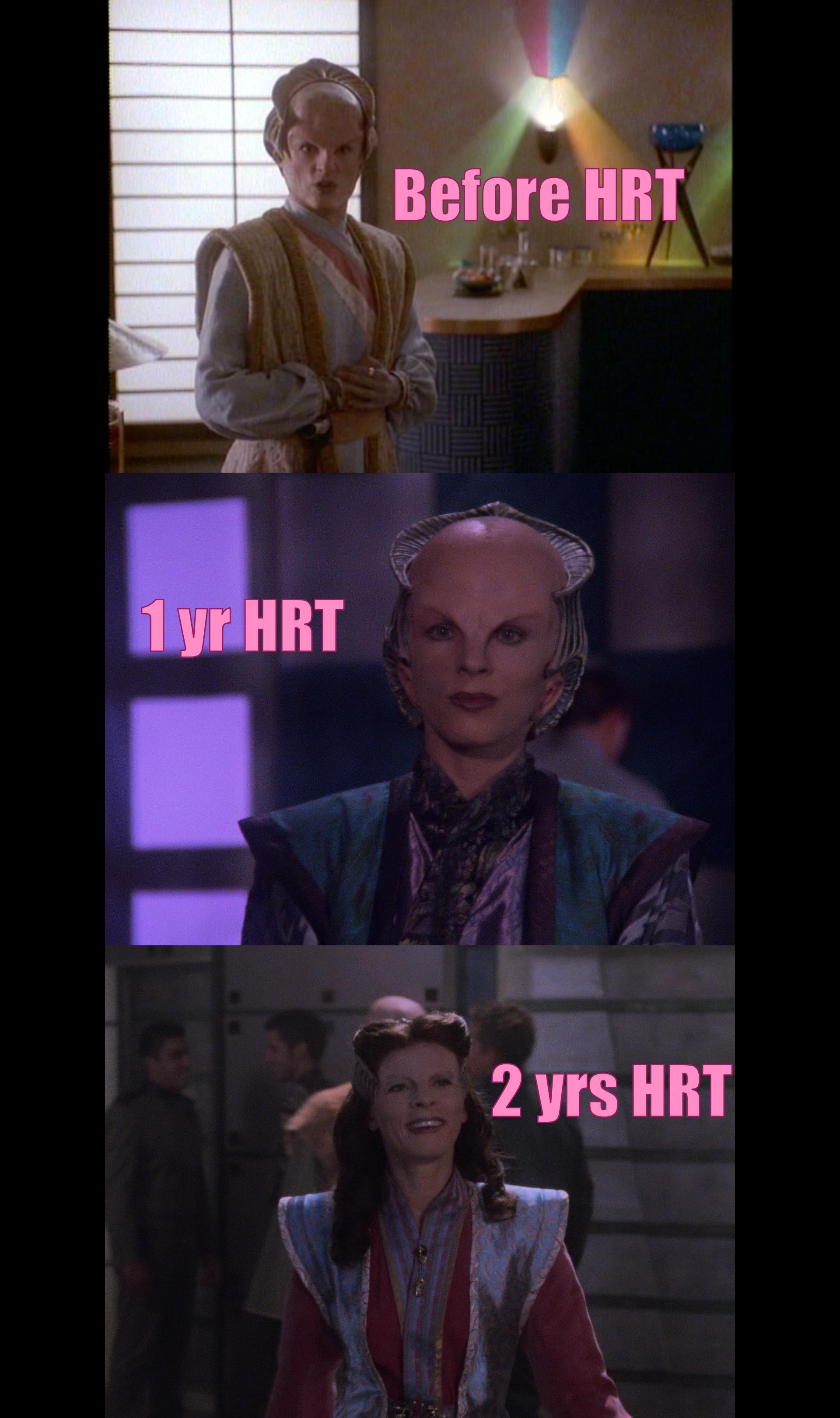 "Before HRT": screenshot of Mira Furlan as Delenn in the Babylon 5 pilot, a more androgynous look with the bald head and bone crest and pointier chin, etc. Also sus trans colors in the bg.

"1 year HRT": screenshot of first-season Delenn, with a more explicitly feminine look but still bald with bone crest.

"2 yrs HRT": screenshot of second-season Delenn after her chrysalis transformation to become more human; she has long brown hair  now and the bone crest sorta... intersects her hair.